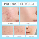 Retinol Gel for Acne and Skin Soothing