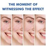 Retinol Gel for Acne and Skin Soothing