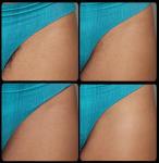 Diode Hair Removal Machine - 3 Wavelengths, Powerful