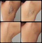 Diode Hair Removal Machine - 3 Wavelengths, Powerful