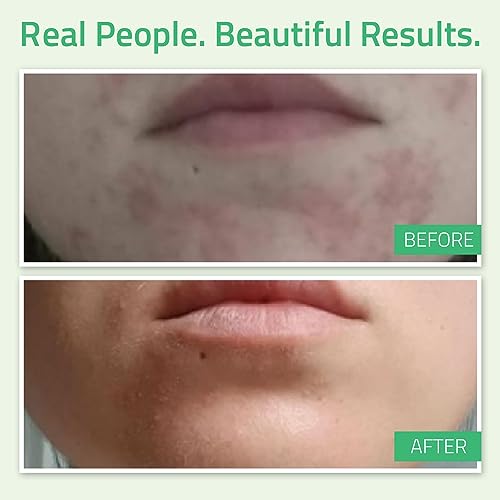 Glycolic Acid Peel with Retinol & Green Tea