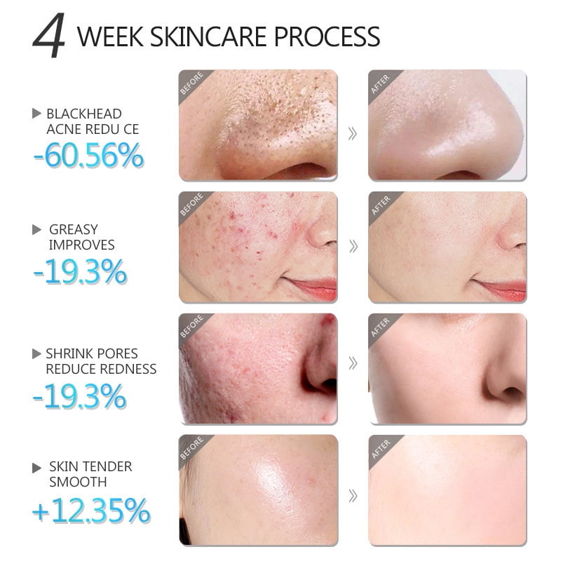 Acne-fighting Mud Mask Trio with Tea Tree