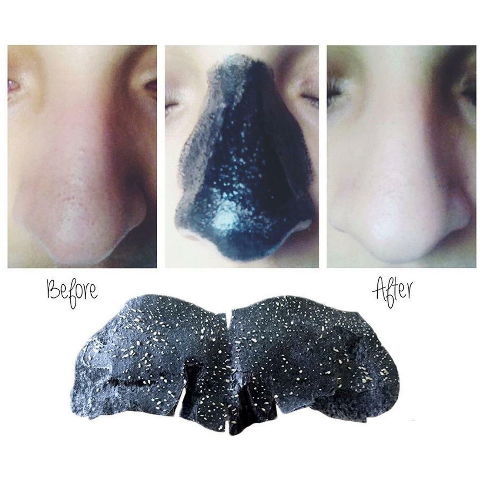 Tagcone 10-Pack Blackhead Nose Strips