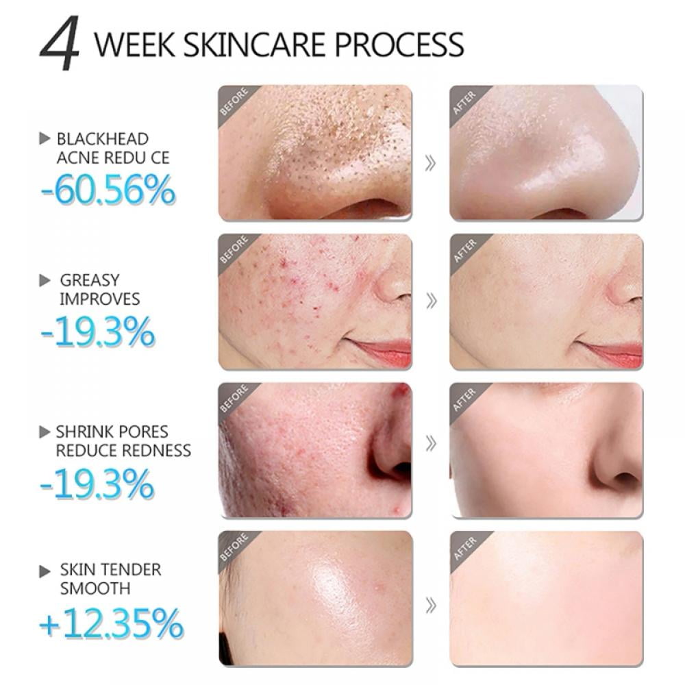 Salicylic Acid Mud Mask - Skincare for All