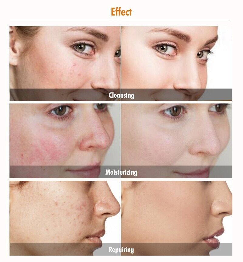 Turmeric Clay Acne Exfoliant with Vitamin C