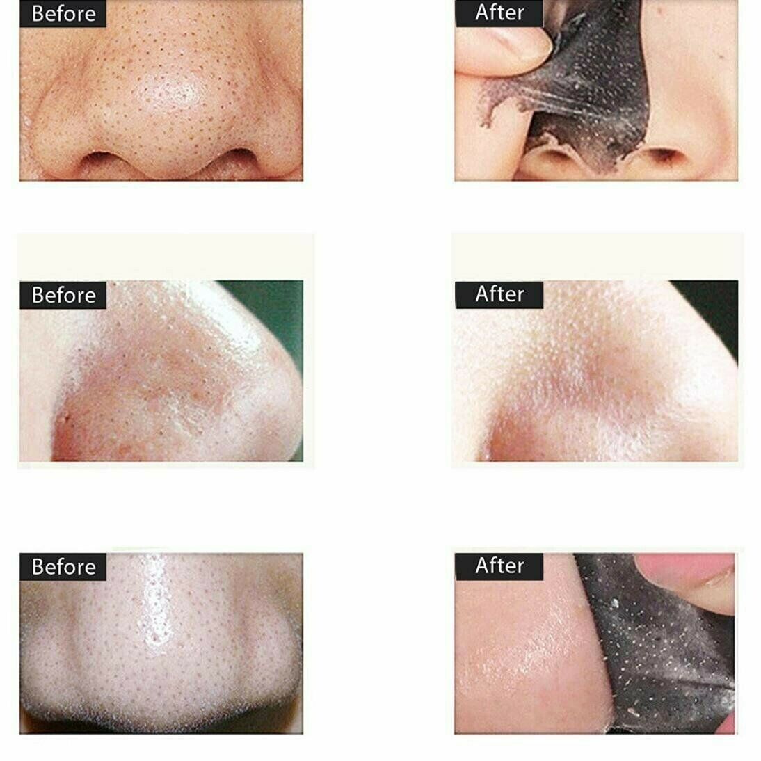 Charcoal Blackhead Remover Mask - Purifying & Acne Fighting
