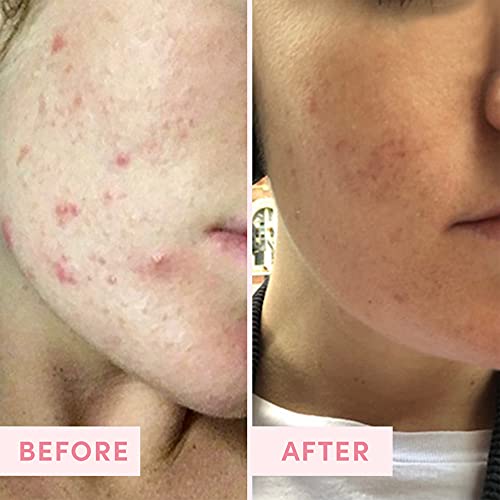 Australian Pink Clay Mask for Pores & Pigmentation