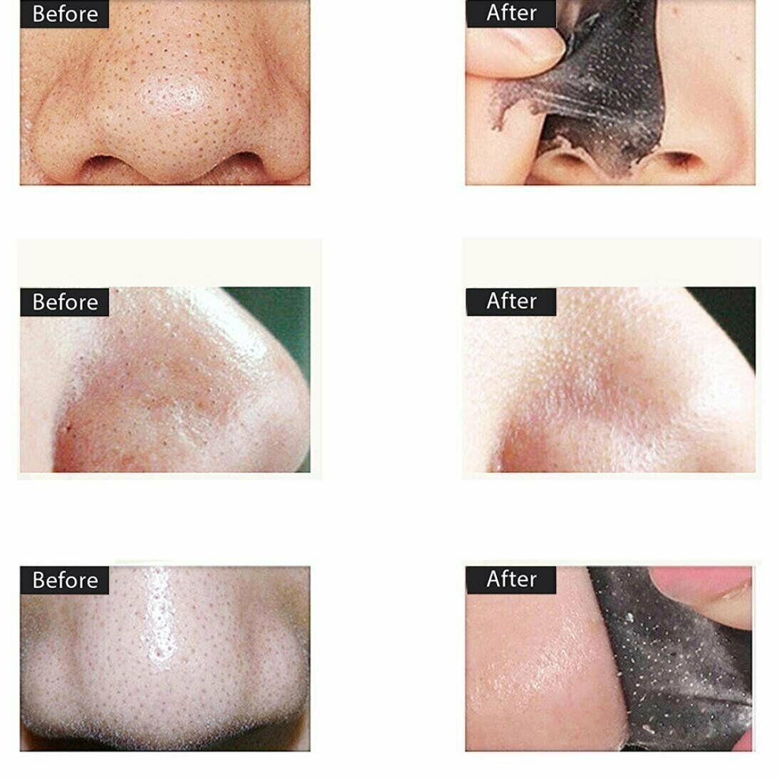 Acne Purifying Charcoal Mask