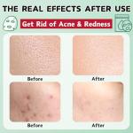 Acne Treatment Mud Mask Set - 6pcs