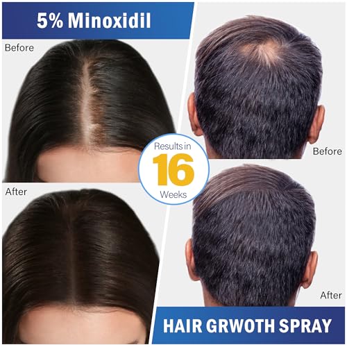 5% Minoxidil Hair Growth Spray for Men and Women