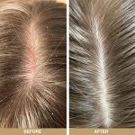 Australian Bodycare Tea Tree Scalp Treatment Set