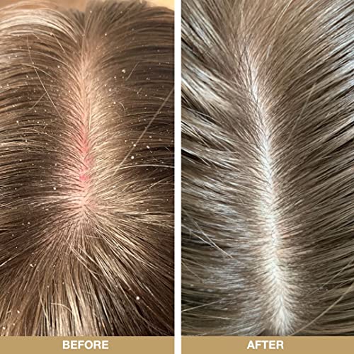 Australian Bodycare Tea Tree Scalp Treatment Set