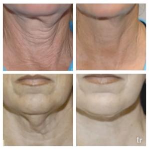 Hyaluronic Acid Anti-Aging Face & Eye Cream