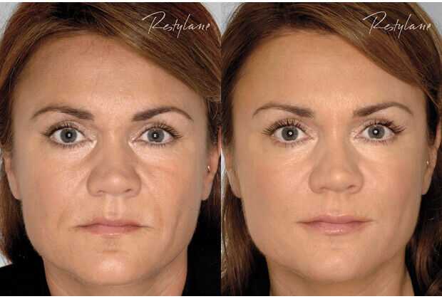 Anti-Aging Phytoceramides Capsules for Wrinkles