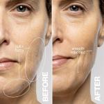 DERMAFLASH Luxe Plus: Anti-Aging Exfoliation Tool