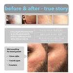 Professional 1.5mm Derma Roller for Hair Growth