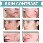 Retinol Gel: Acne Treatment & Anti-Aging Cream