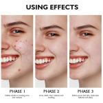 Retinol Gel: Acne Treatment & Anti-Aging Cream