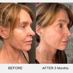 Micro Infusion Anti Aging Serum for Home Use