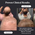 KilgourMD Scalp Serum for Hair Loss and Anti-Aging