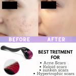 Derma Roller for Hair and Beard Growth