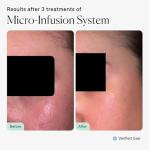 Micro Infusion Face Kit for Deep Hydration