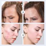 GESS DARS High Frequency Massage Device for Skin