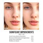 Korean Anti-Acne Serum with AHA and BHA