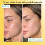 Daily Exfoliator for Clear Skin with Niacinamide