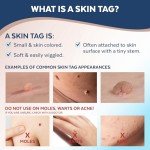 Skin Tag Remover - FDA-Cleared Cryogenic Device