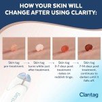 Skin Tag Remover - FDA-Cleared Cryogenic Device