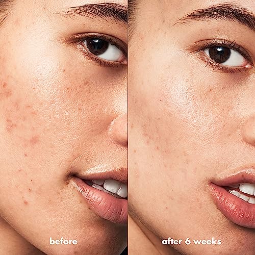 e.l.f. SKIN Vegan Blemish Control Travel Kit
