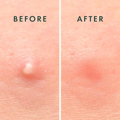 Rael Pimple Patches - Overnight Spot Cover, Acne Patch