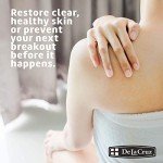 De La Cruz Sulfur Ointment for Acne Treatment