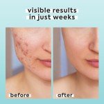 Natural Hypochlorous Acid Spray for Skin Relief