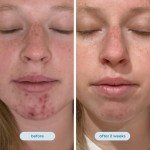 Soothing Hypochlorous Acid Mist for Sensitive Skin