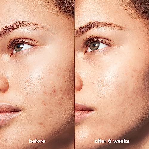 e.l.f. SKIN Blemish Breakthrough Resurfacing Night Serum