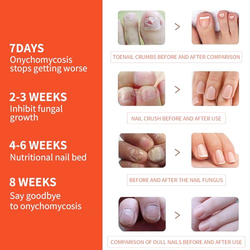 Toenail Fungus Treatment Extra Strength,Toe Nail Fungus Treatments 32 Pcs,Nighttime Renewal Fungus Nail Treatment Patch,One Patch Every Night for Effective Symptom Relief,Visible Results At A Glance