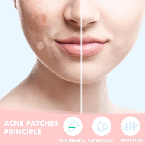 sundpik Pimple Patches for Face 304pcs,Hydrocolloid Acne Patches Star,Zit Patches,Pimple Popper Tool Kit,Facial Skin Care Products Containing Salicylic Acid,Tea Tree Oil and Calendula Oil(304)