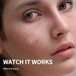 Daolyo Pimple Patches for Face, 4 Size 300 Counts Acne Patches, Hydrocolloid Patches for Covering Zits and Blemishes, Spot Stickers with Salicylic Acid, Tea Tree Oil & Calendula Oil