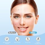 QUSTERE Pimple Patches for Face, Hydrocolloid Acne Patches, Cute Round Shape Zit Covers, Spot Stickers with Tea Tree, Salicylic Acid & Cica Oil| 2 Sizes (9mm, 12mm) |288 Count