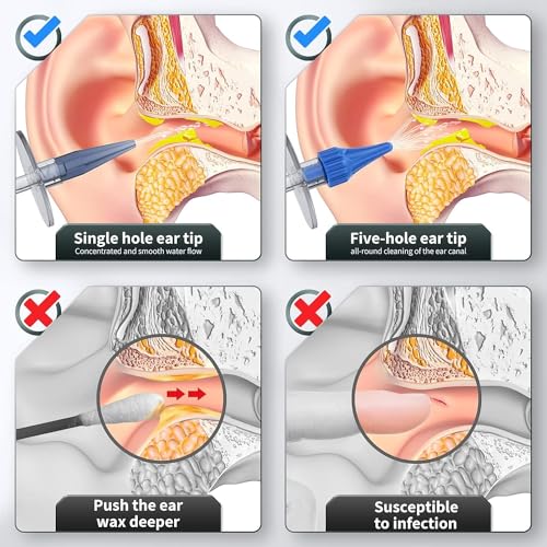 WEUANY Ear Wax Removal, Ear Cleaner, Earwax Removal Kit, Manual Ear Irrigation Flushing System, Ear Cleaning Kit, Safe and Effective to Clean Ear Built Up Wax