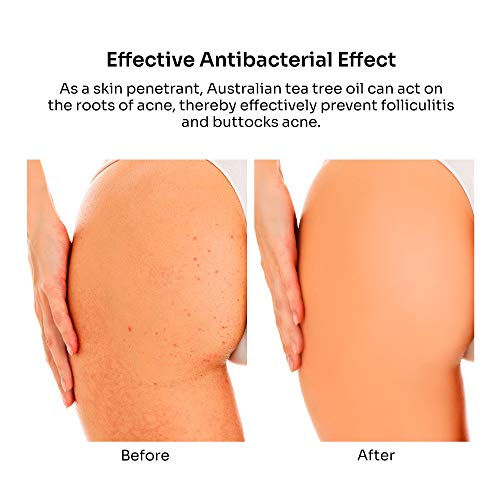 Hydrating Butt Lotion with Plant Extracts for Acne