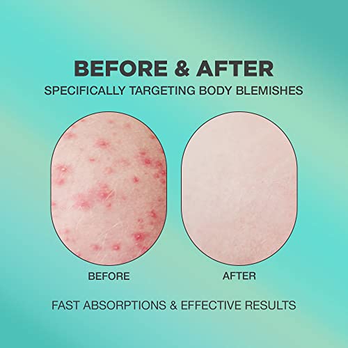 Natural Formula Butt Acne Clearing Treatment Lotion