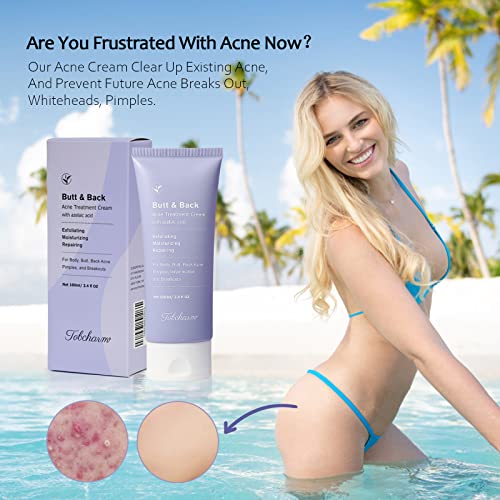 Tobcharm Acne Treatment for Back, Butt, Body - 3.4 fl. oz
