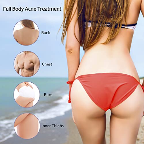 Tobcharm Acne Treatment for Back, Butt, Body - 3.4 fl. oz