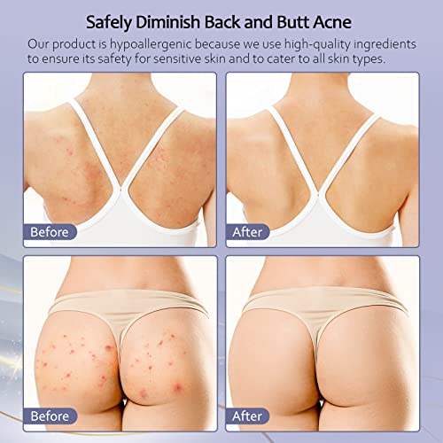 Tobcharm Acne Treatment for Back, Butt, Body - 3.4 fl. oz