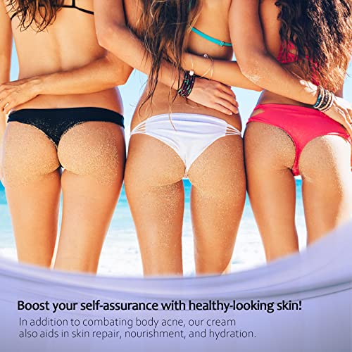 Tobcharm Acne Treatment for Back, Butt, Body - 3.4 fl. oz
