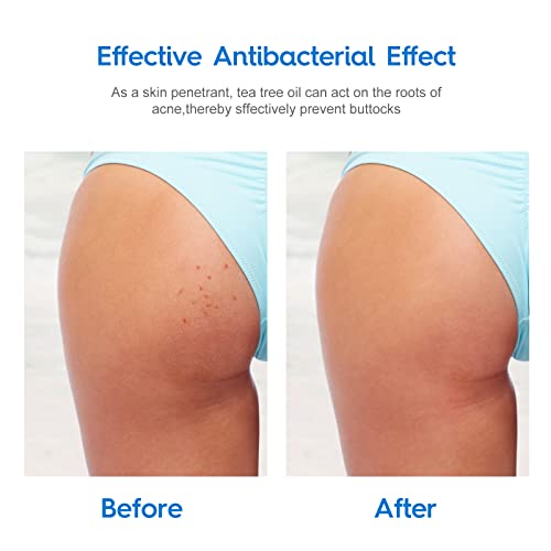 Butt Acne Clearing Treatment (3.5 OZ) - Zits, Pimples