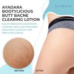 Ayadara 8oz Smoothing Salicylic Acid Butt Acne Cream